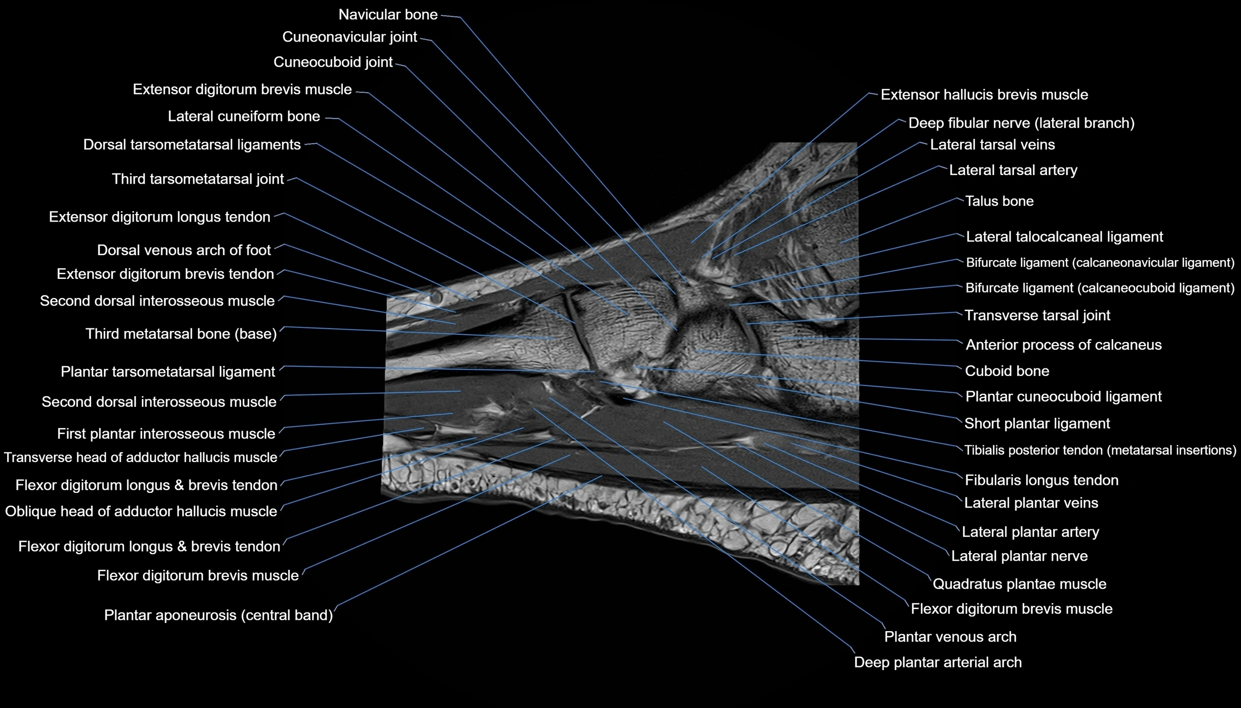 MRI mid foot sagittal cross sectional anatomy 3T  radiology  image-img-00001-00019.webp